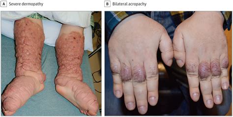 Thyroid-Related Orbitopathy, Restrictive Strabismus, Dermopathy, and Acropachy. | Dermatology ...