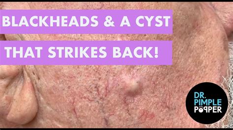 BLACKHEADS & The Cyst that Strikes Back - YouTube