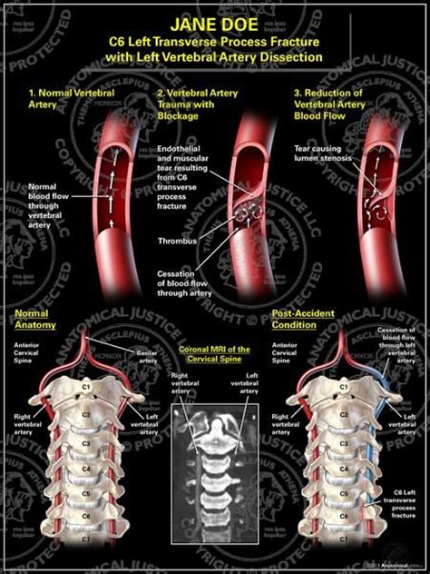 110 Bilateral Carotid + Vertebral Artery Dissection Awareness ideas ...