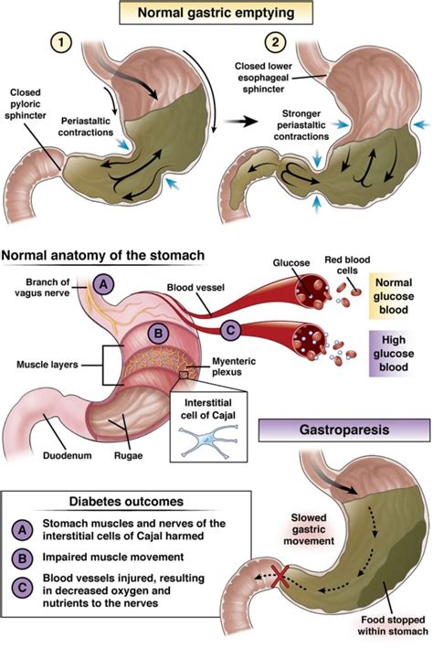 Diabetic gastroparesis - AGA GI Patient Center