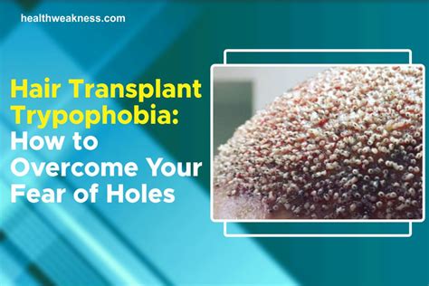 Hair Transplant Trypophobia: How To Overcome Your Fear Of Holes 2023