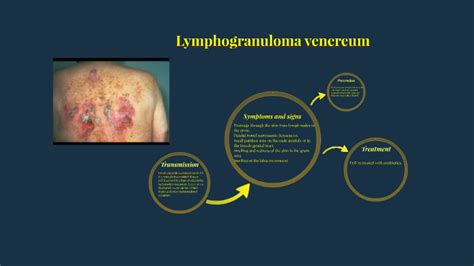 Lymphogranuloma venereum by alexis blandon on Prezi