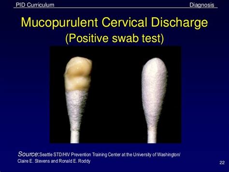 Pelvic Inflammatory Disease - Case study, patterns and association