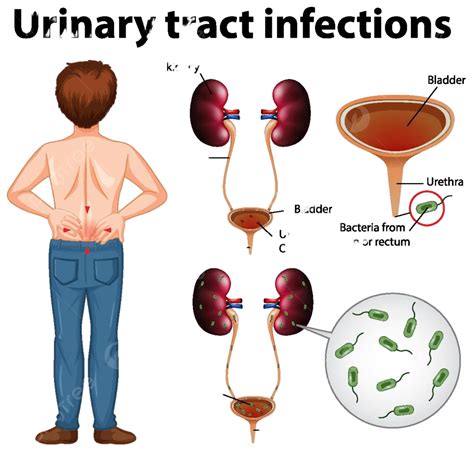 Informative Illustration Of Urinary Tract Infections Pain Unwell Infections Vector, Pain, Unwell ...