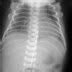 Hyaline Membrane Disease (HMD) - Nursing Care Plan - NANDA - Nursing Diagnosis