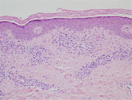 A Case of Childhood Lichen Aureus