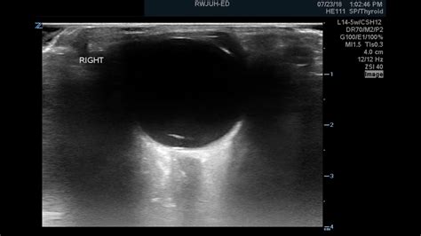 Retinal Detachment Ultrasound