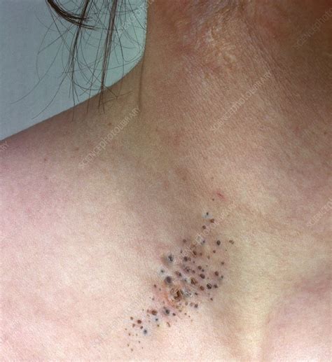 Nevus comedonicus - Stock Image - C014/6914 - Science Photo Library