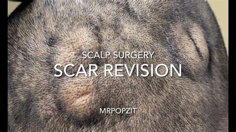 Chronic Pilar cyst patient Scalp Scar revision surgery. Removing extra skin and scar tissue ...