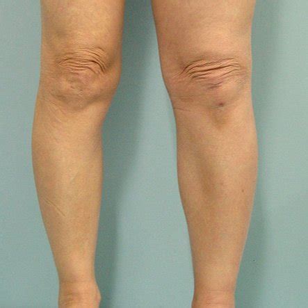 A photograph showing the swelling of the left leg. | Download Scientific Diagram