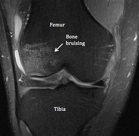 Bone Bruise - Causes, Symptoms, Diagnosis, Treatment & Healing Time