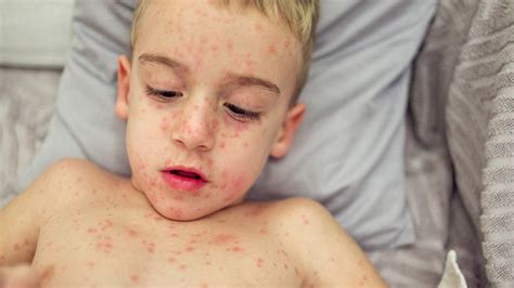 Measles Rash Face