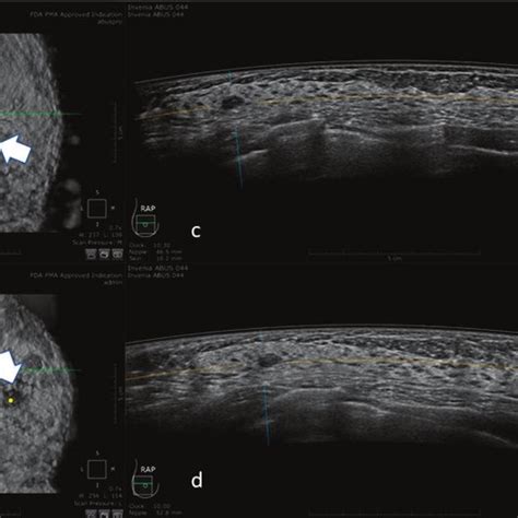 Comparison of sensibility and specificity of ABUS (Automatic Breast ...