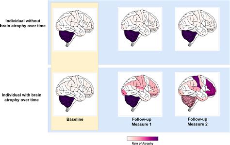 Evaluating brain atrophy as an endophenotype for genetic studies of ...