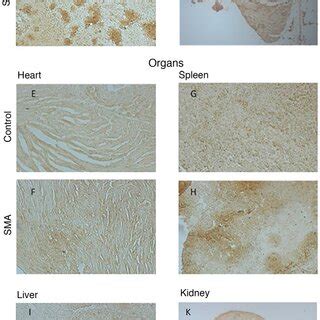 Pimonidazole labeling shows widespread hypoxia in SMA. To test for ...