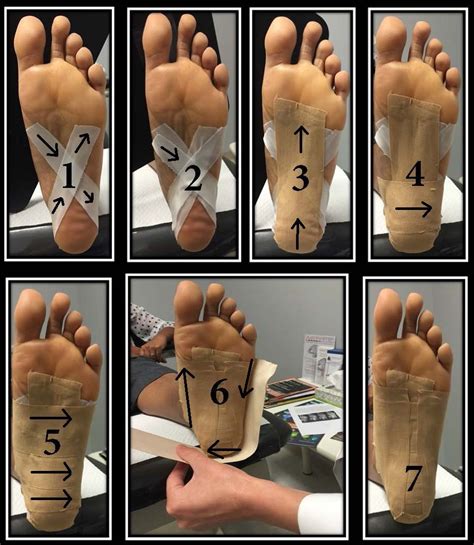 Plantar Fasciitis Taping Diagram