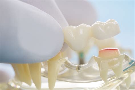 Avoiding Dental Bridge Problems | How to Take Care of Dental Bridges