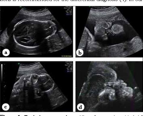 Figure 1 from Prenatal diagnosis of frontonasal dysplasia with anterior ...