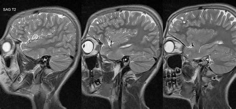 Dr Balaji Anvekar FRCR: Frontal subcortical white matter cystic lesions MRI