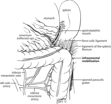 Anterior and Low Anterior Resection of the Rectum | Basicmedical Key