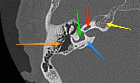 Otic capsule - blue arrow: otic capsule (dense bone) - yellow arrow: petrous apex - orange arrow ...