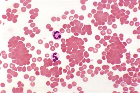 Cold autoimmune hemolytic anemia | Pathology Student