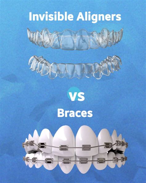 Invisible Aligners vs Braces | Power Smiles Dental Clinic