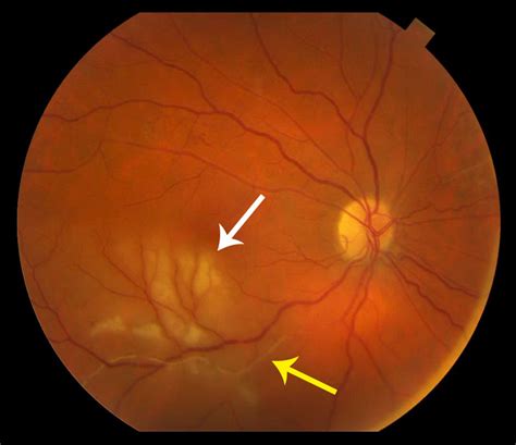 Retinal Vasculitis Symptoms, Causes & Treatment