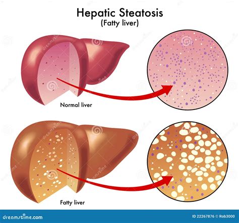 Hepatic Steatosis Royalty Free Stock Image - Image: 22267876