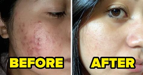 26 Skincare Before And Afters That Are Super Convincing