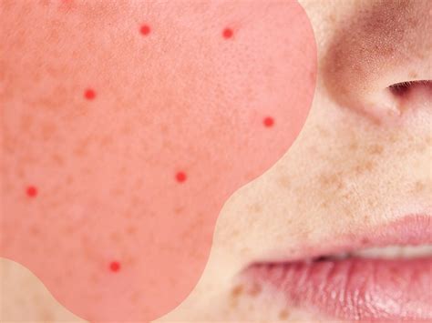 How to Tell if Your 'Acne' Might Actually Be Rosacea | SELF