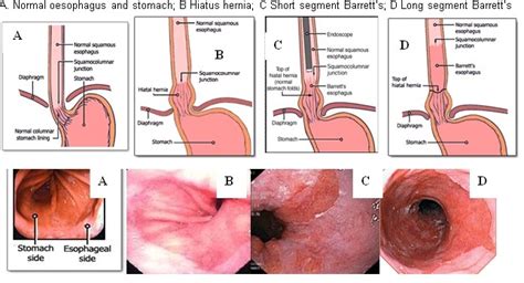 Does Barretts Esophagus Lead To Cancer - CancerWalls