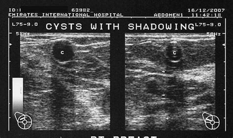 Breast Cyst Ultrasound