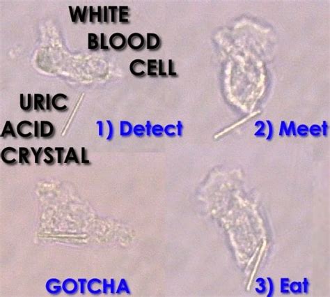 Uric Acid Crystal Pictures | GoutPal Gout Help