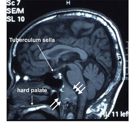 Shows sagittal view of magnetic resonance imaging (MRI) of a... | Download Scientific Diagram