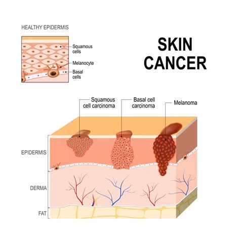 What is Squamous Cell Carcinoma? - Facty Health