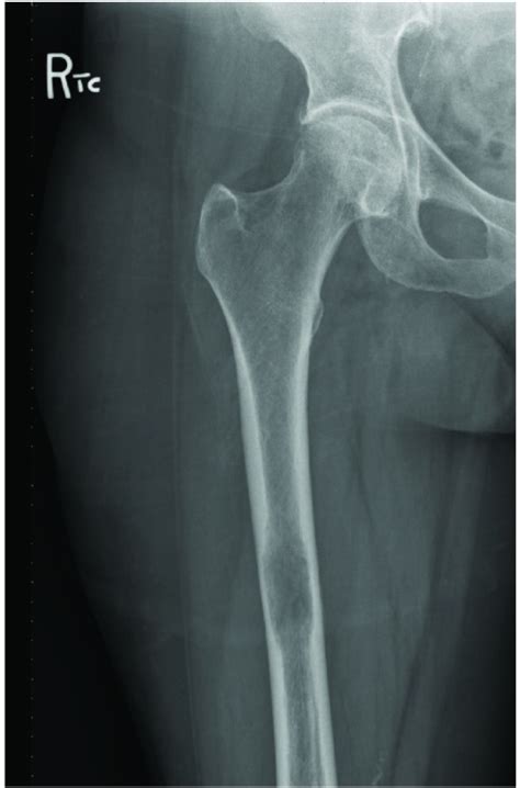 X-Ray right femur, AP view, demonstrates a large lucent lesion of the right femur with endosteal ...