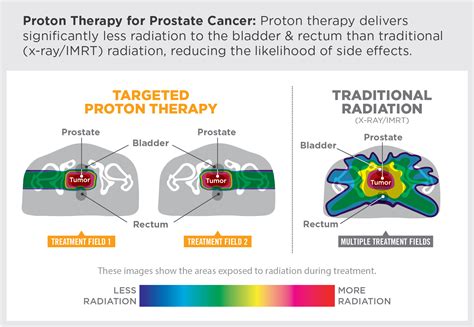 Fight Cancer With Protons – Provision CARES Proton Therapy Knoxville