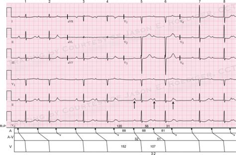 Ventriculophasic sinus arrhythmia | ECG Guru - Instructor Resources