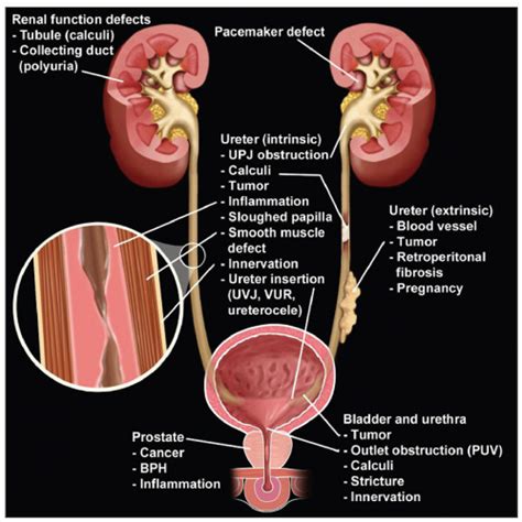 Introduction to Impediments to Urine Flow | Basicmedical Key