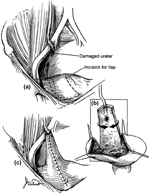 A Boari flap: a flap of bladder is fashioned into a tube and an... | Download Scientific Diagram