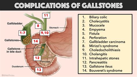 Gallbladder Surgery Complications Gallstone Clinic | The Best Porn Website