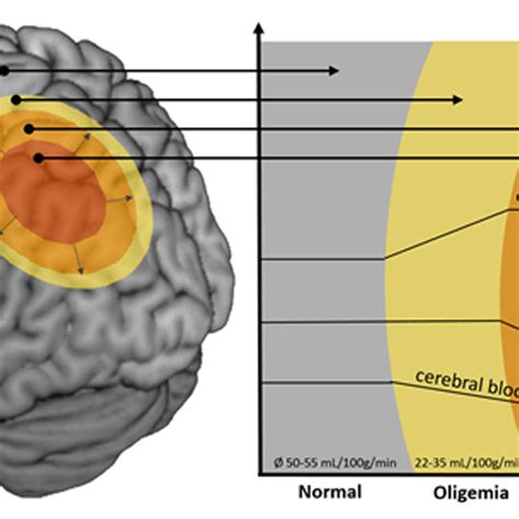 Illustration of the penumbra concept. Infarct core (red): infarcted... | Download Scientific Diagram