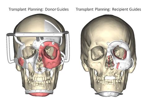 Groundbreaking Double Partial Face and Eye Transplant Surgery at NYU ...