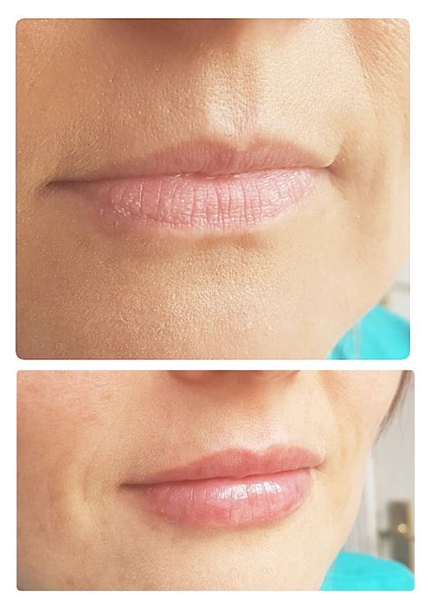 HYALURONIC ACID, Lip fillers – Permanent Beauty Fabrique Marta Szewczyk