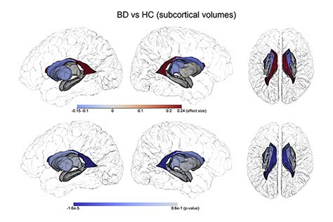 Promising new bipolar disorder study reveals structural brain changes over time - HSC News