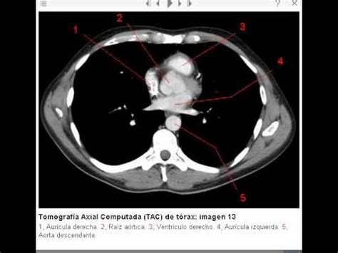 Tomografía Axial Computada (TAC) de tórax (ventana mediastinal) - YouTube