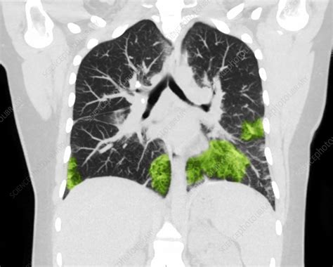 Lungs with vaping damage, baseline CT - Stock Image - C050/4472 - Science Photo Library