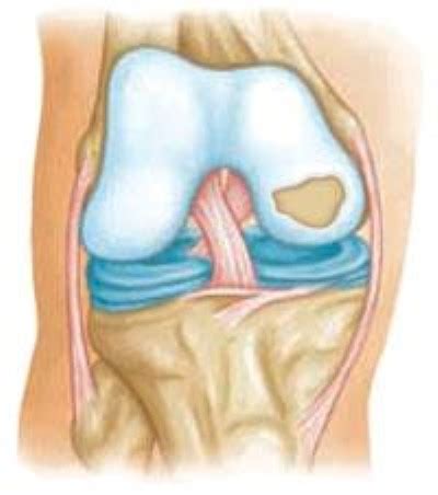 Articular Cartilage Restoration - OrthoInfo - AAOS