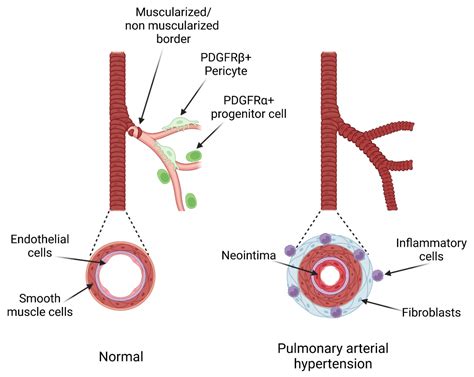 Life | Free Full-Text | The Platelet-Derived Growth Factor Pathway in Pulmonary Arterial ...